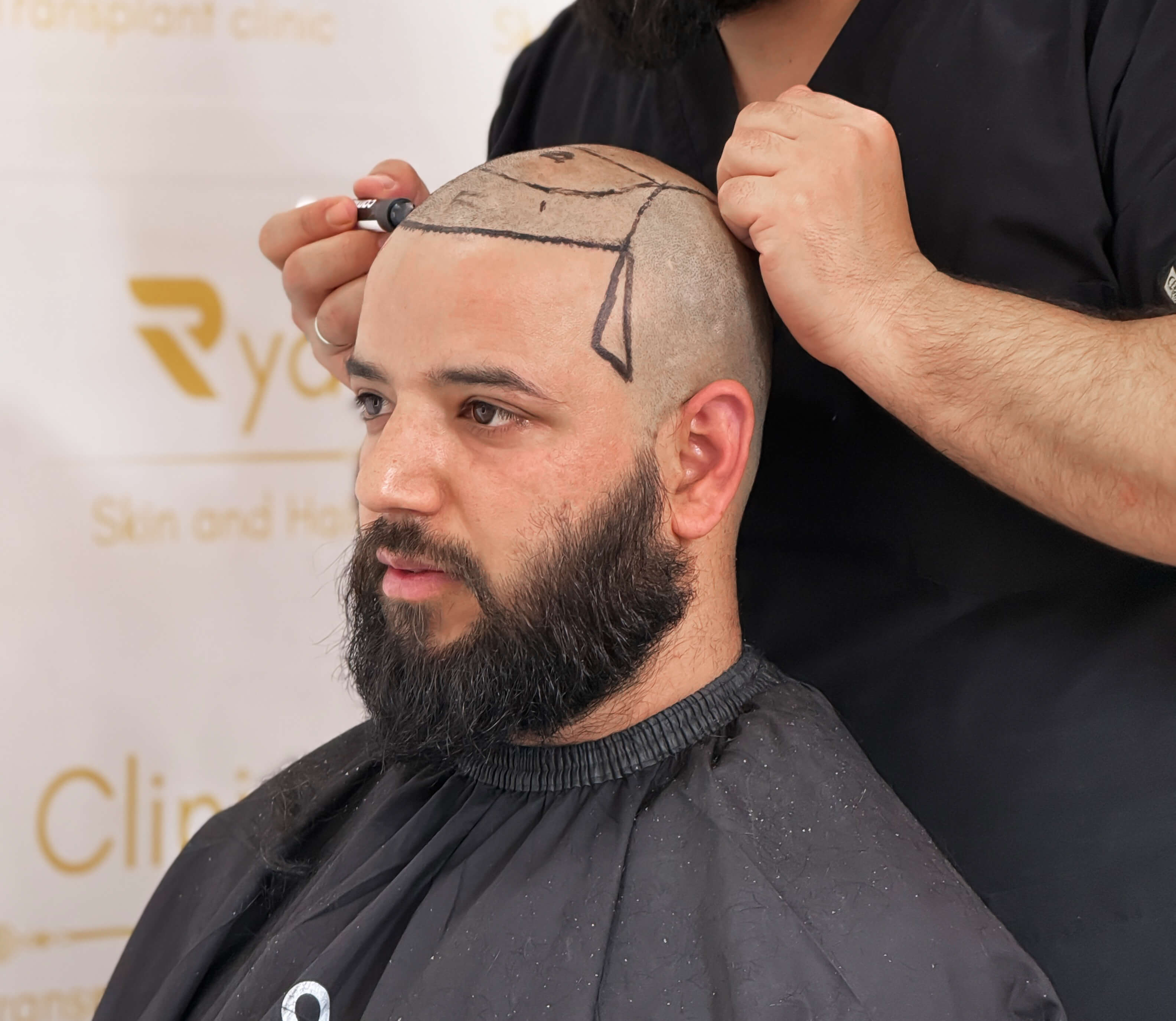Tool on scalp